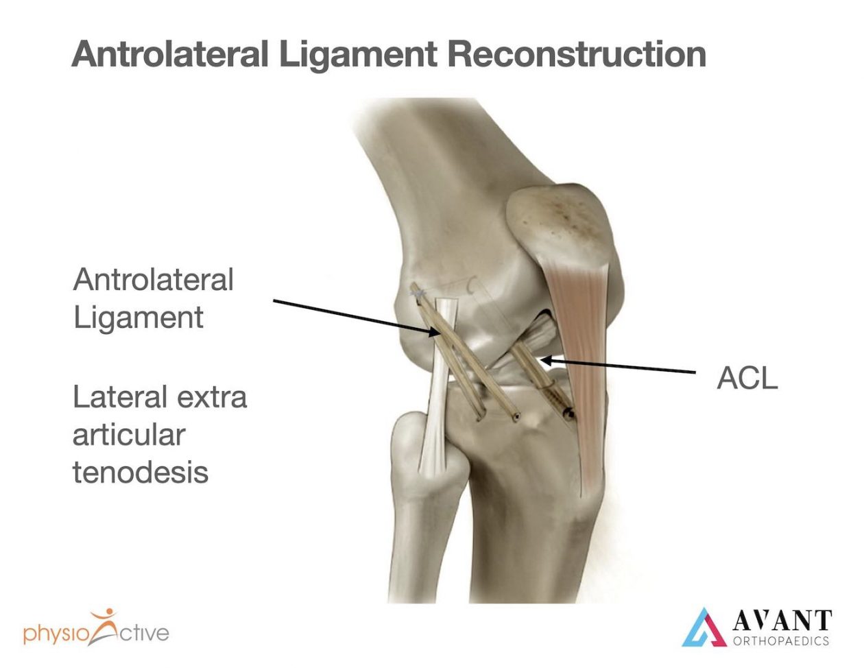 ACL Repair / Reconstruction with Dr Ramesh Subramaniam | PhysioActive ...